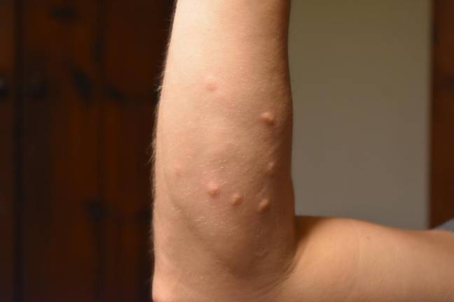 Itchy, raised bumps caused by brushing against a spongy moth caterpillar, whose tiny hairs carry histamines to which some people have a reaction.